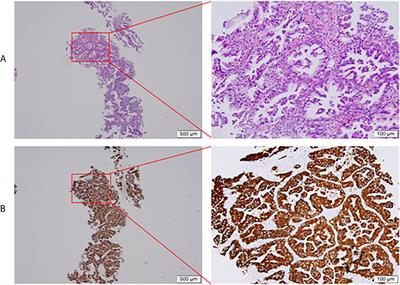 Case Report: Neoadjuvant and Adjuvant Crizotinib Targeted Therapy in Stage IIIA-N2 ALK-Positive Non-Small-Cell Lung Cancer